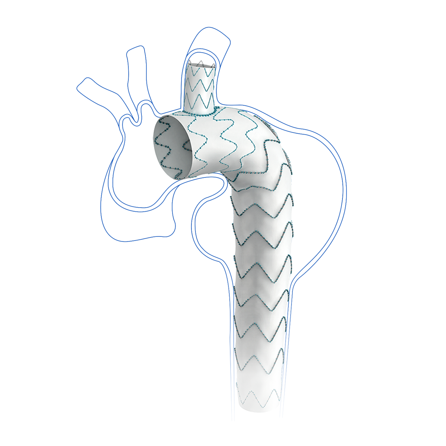 Cratos™ Thoracic Branch Stent Graft System